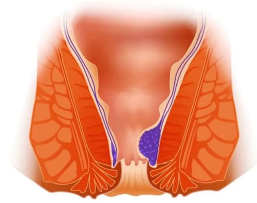 Hemorrhostop ผลิตภัณฑ์