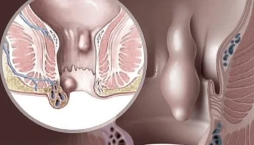 Hemorrhostop วิธีใช้